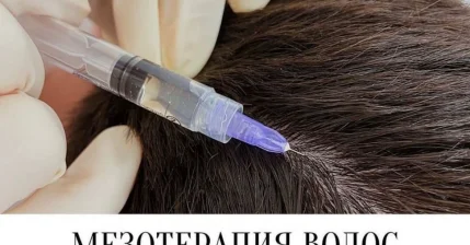 Мезотерапия волос 